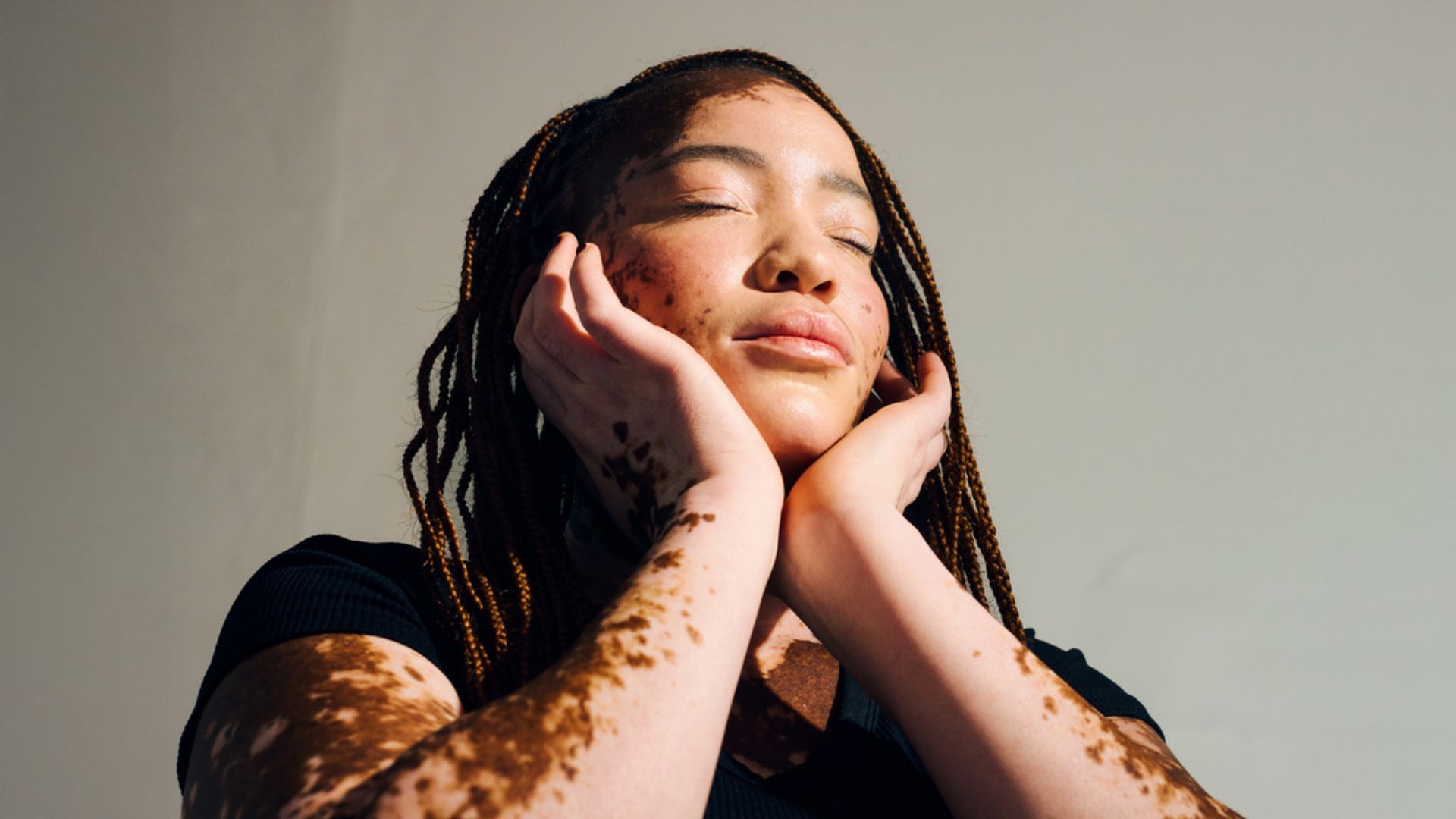 Vrouw met vitiligo en gevlochten haar laat haar gezicht met gesloten ogen in haar handen rusten.